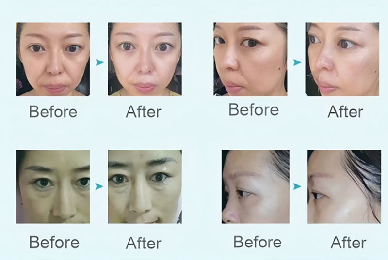 Full Molecular Hyaluronic Acid Mask