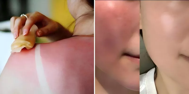 Sunscreen Repairing Liquid Dressing